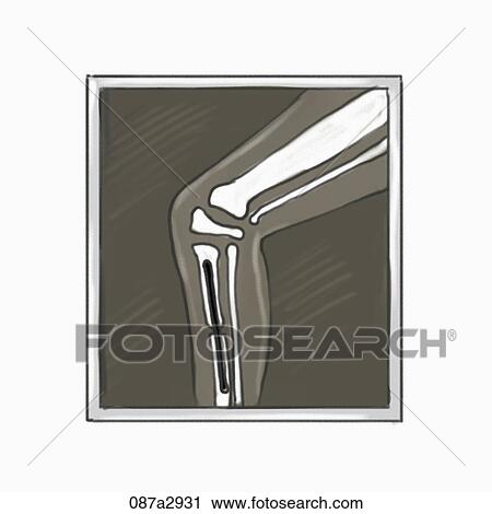 Illustration of x-ray film of broken leg View Large Illustration Clip Art - Illustration of x-ray film of broken leg. Fotosearch