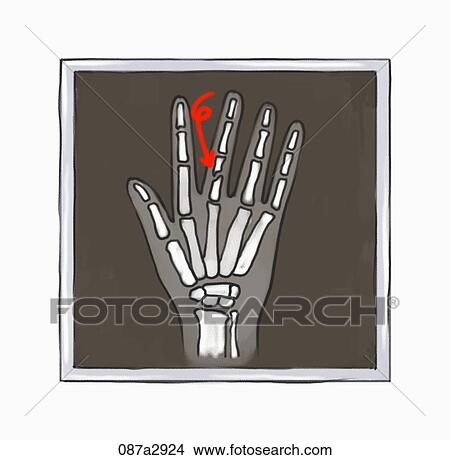 Stock Illustration - Illustration of x-ray film of broken finger. Fotosearch