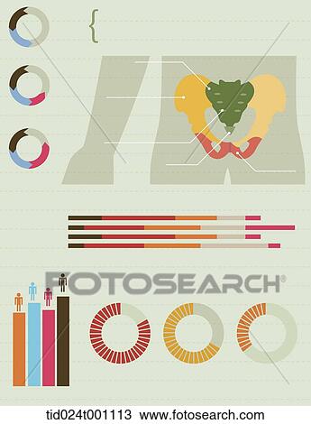 Drawing - illustration info graphics of hip. Fotosearch