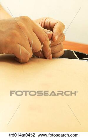 person, needle, Oriental medicine, Oriental, Oriental culture, Oriental medicine, traditional medicine View Large Photo Image Stock Image - person, needle, Oriental medicine, Oriental, Oriental culture, Oriental medicine, traditional medicine. Fotosearch