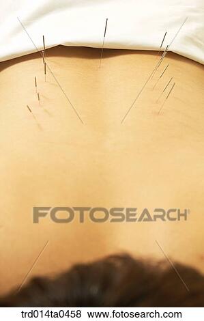 Stock Photo - person, needle, Oriental medicine, Oriental, Oriental culture, Oriental medicine, traditional medicine. Fotosearch