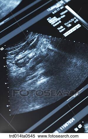 Stock Photography - medical treatment, medicine, supersonic waves, supersonic waves inspection, embryo, pregnancy, obstetrics and gynecology. Fotosearch
