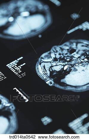 medical treatment, medicine, X-ray, dislocation, dislocation photograph, dislocation, close up View Large Photo Image Stock Image - medical treatment, medicine, X-ray, dislocation, dislocation photograph, dislocation, close up. Fotosearch