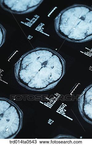 medical treatment, medicine, X-ray, dislocation, dislocation photograph, dislocation, close up View Large Photo Image Stock Image - medical treatment, medicine, X-ray, dislocation, dislocation photograph, dislocation, close up. Fotosearch