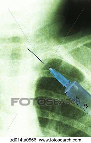 Stock Photograph - medical treatment, medicine, X-ray, X-rayphotograph, x-ray, syringe, injection. Fotosearch
