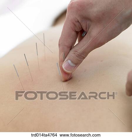 Chinese medicine oriental medicine/hand applying accupuntue on patient's back View Large Photo Image Picture - Chinese medicine oriental medicine/hand applying accupuntue on patient's back. Fotosearch
