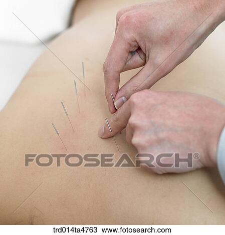 Stock Image - Chinese medicine oriental medicine/hand applying accupuntue on patient's back. Fotosearch