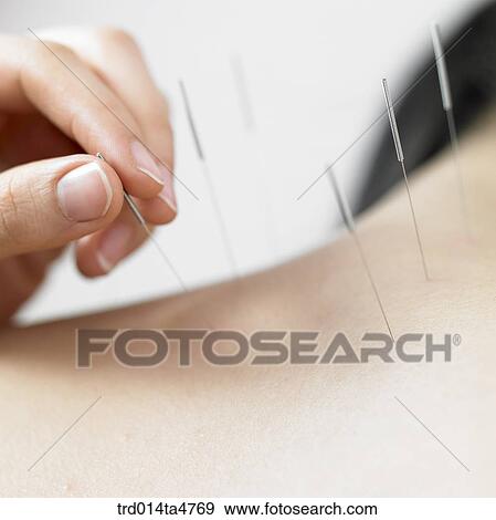 Chinese medicine oriental medicine/hand applying accupunture on patient's neck View Large Photo Image Stock Photo - Chinese medicine oriental medicine/hand applying accupunture on patient's neck. Fotosearch