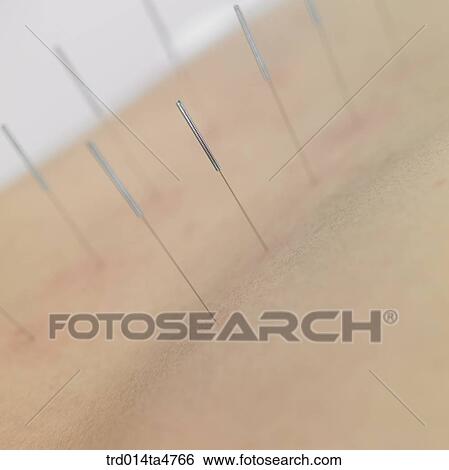 Chinese medicine oriental medicine/patient's back with needles View Large Photo Image Stock Photograph - Chinese medicine oriental medicine/patient's back with needles. Fotosearch