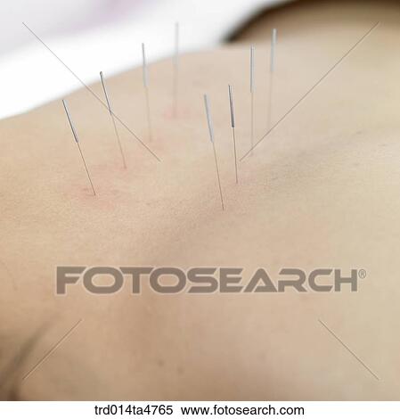 Chinese medicine oriental medicine/patient's back with needles View Large Photo Image Stock Photography - Chinese medicine oriental medicine/patient's back with needles. Fotosearch