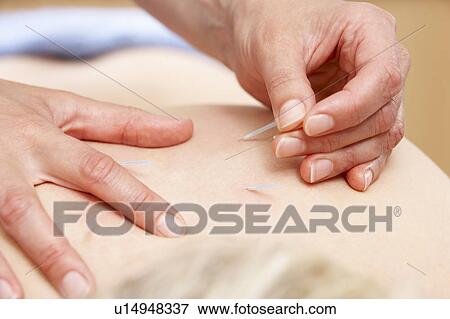 Acupuncturist treating female client View Large Photo Image Stock Photo - Acupuncturist treating female client. Fotosearch
