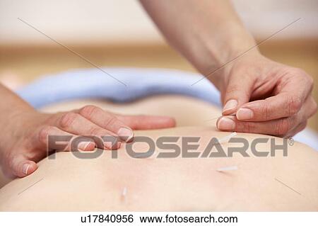 Acupuncturist treating female client View Large Photo Image Stock Photograph - Acupuncturist treating female client. Fotosearch