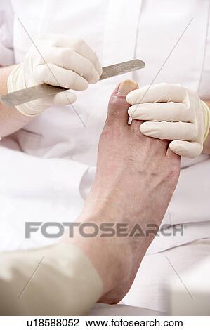 Stock Image - Chirpodist treating client in clinic. Fotosearch