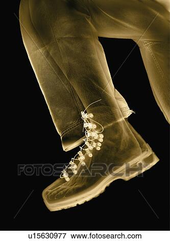 Stock Photo - X-ray of leg and boot. Fotosearch