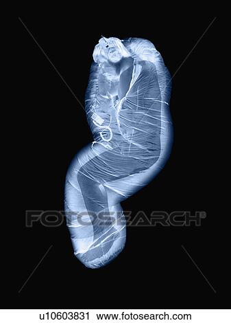 Stock Image - X-ray of person in sleeping bag. Fotosearch