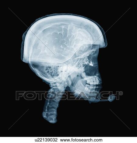 Stock Image - X-ray of skull. Fotosearch
