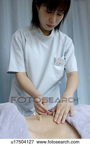 Female doctor applying moxa to a man View Large Photo Image Stock Photo - Female doctor applying moxa to a man. Fotosearch