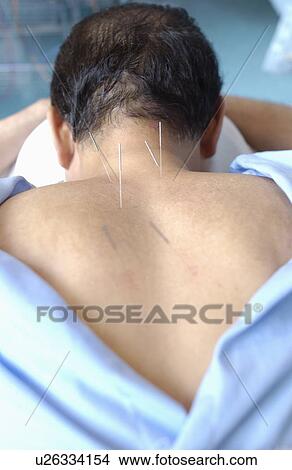 Picture - Man with acupuncture needles on shoulders, close up. Fotosearch