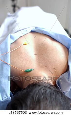 Man with acupuncture needles on shoulders, close up View Large Photo Image Stock Image - Man with acupuncture needles on shoulders, close up. Fotosearch