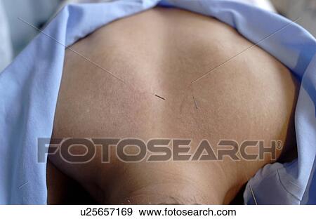 Stock Photo - Man with acupuncture needles on shoulders, close up. Fotosearch