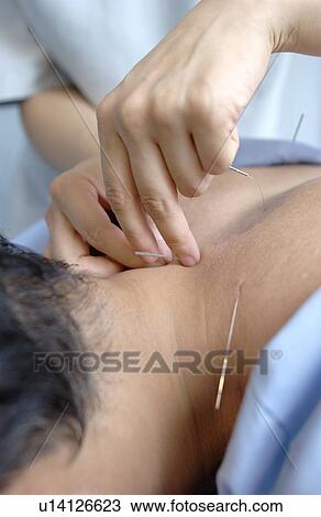Stock Image - Young woman putting acupuncture needles on man's shoulders, close up. Fotosearch