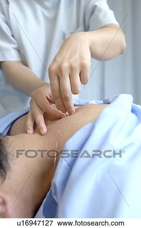 Stock Photo - Young woman putting acupuncture needles on man's back, close up. Fotosearch
