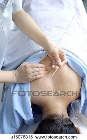 Stock Photography - Young woman putting acupuncture needles on man's back. Fotosearch
