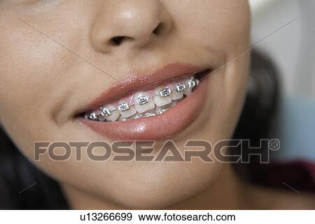 Stock Photo - Teenage Girl (14-16) wearing teeth braces, (close-up). Fotosearch
