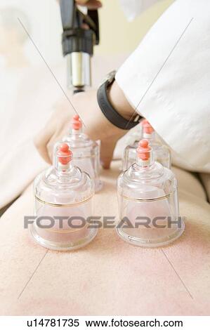 Stock Photography - Chinese traditional cupping therapy for improved circulation. Fotosearch