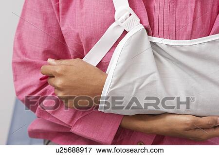 Woman's arm in sling View Large Photo Image Stock Photo - Woman's arm in sling. Fotosearch
