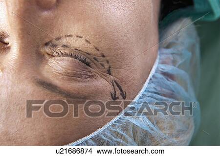 Close up of patient's face with incision lines View Large Photo Image Picture - Close up of patient's face with incision lines. Fotosearch