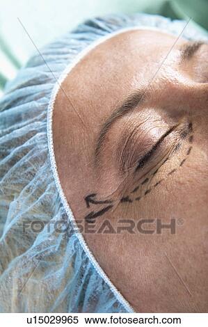 Close up of patient's face with incision lines View Large Photo Image Stock Photography - Close up of patient's face with incision lines. Fotosearch