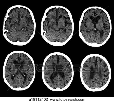 脳 で Alzheimer の病気 Ct 走査 ストックイメージ U Fotosearch