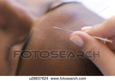 Acupuncture View Large Photo Image Picture - Acupuncture. Fotosearch