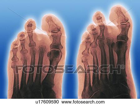 Stock Image - Amputated toe, X-ray. Fotosearch