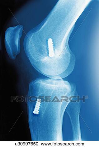 Stock Image - Anterior cruciate ligament repair, X-ray. Fotosearch