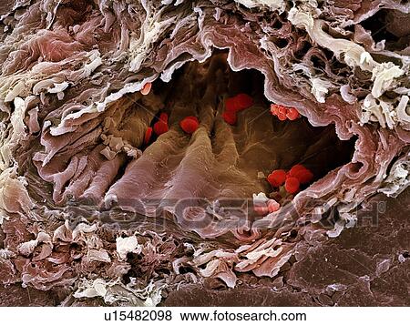 Stock Photo - Artery SEM. Fotosearch