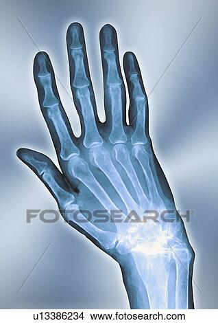 Picture - Arthritic hand, X-ray. Fotosearch