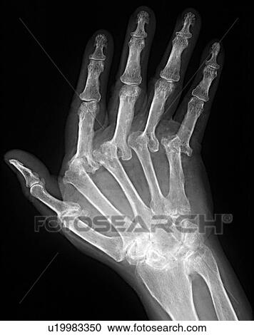 Arthritic hand, X-ray View Large Photo Image Stock Image - Arthritic hand, X-ray. Fotosearch