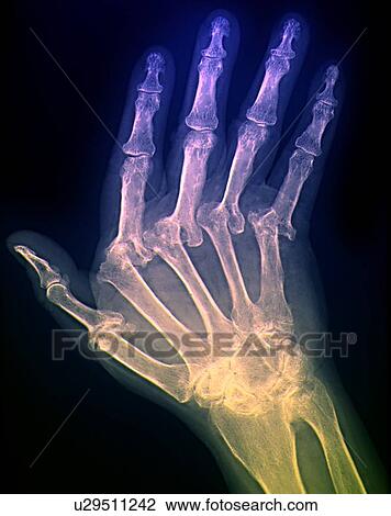 Arthritic hand, X-ray View Large Photo Image Stock Image - Arthritic hand, X-ray. Fotosearch