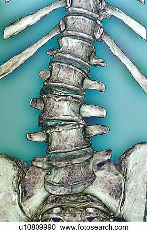 Arthritis of the spine, CT scan View Large Photo Image Stock Image - Arthritis of the spine, CT scan. Fotosearch