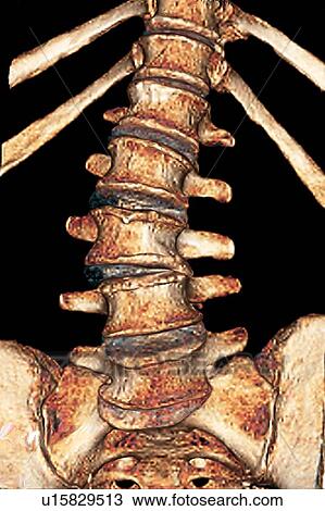 Stock Image - Arthritis of the spine, CT scan. Fotosearch