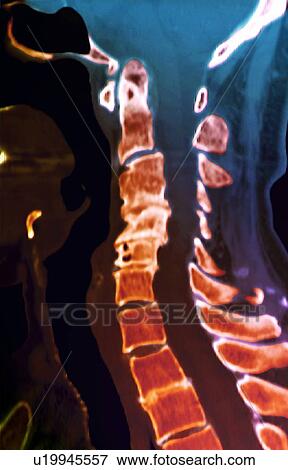 Arthritis of the spine, CT scan View Large Photo Image Stock Photo - Arthritis of the spine, CT scan. Fotosearch