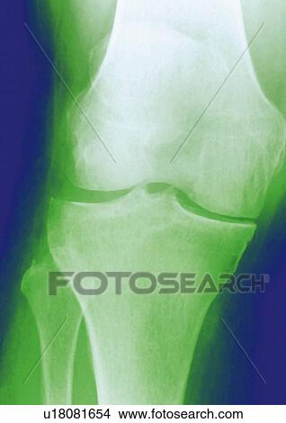 Arthrosis of the knee, X-ray View Large Photo Image Picture - Arthrosis of the knee, X-ray. Fotosearch