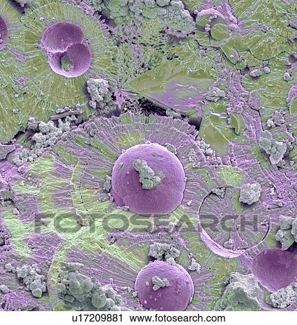 Stock Image - Bladder stone, SEM. Fotosearch