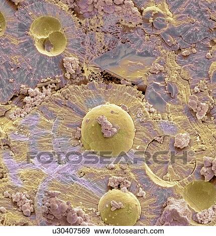 Stock Photo - Bladder stone, SEM. Fotosearch