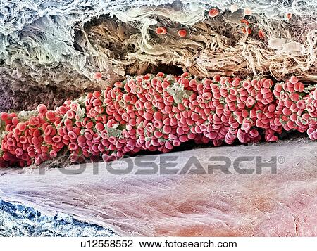 Blood clot, SEM View Large Photo Image Stock Image - Blood clot, SEM. Fotosearch