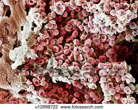 Blood clot, SEM View Large Photo Image Stock Image - Blood clot, SEM. Fotosearch