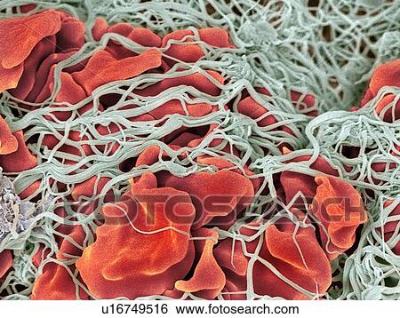 Stock Photograph - Blood clot, SEM. Fotosearch