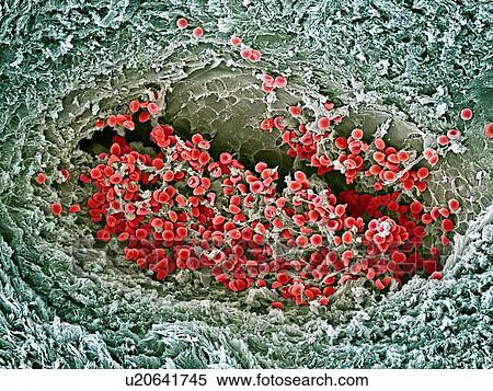 Blood clot, SEM View Large Photo Image Stock Photography - Blood clot, SEM. Fotosearch